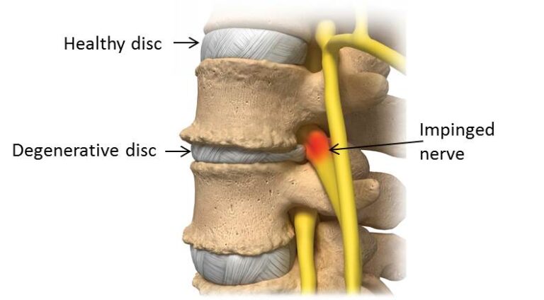 A Closer Look at Degenerative Disc Disease (And What You Can Do About It)