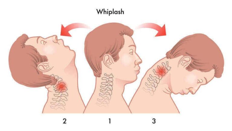 Why You Shouldn’t Ignore Your Whiplash Symptoms