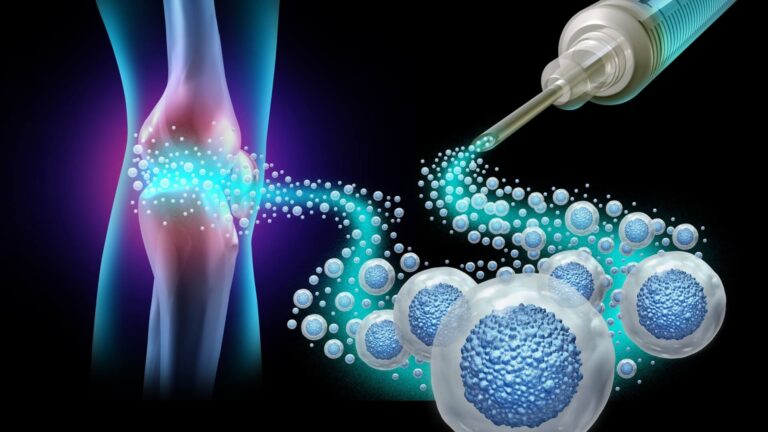 The Regenerative Medicine Window: Why Osteoarthritis Grade Determines Your Treatment Options